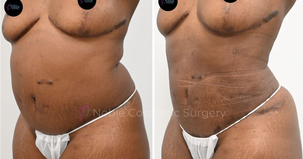 P18-00918L | Before and After Liposuction 2