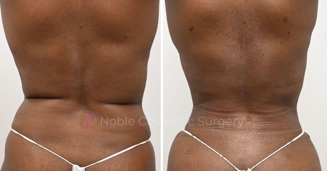 P18-00918L | Before and After Liposuction 3