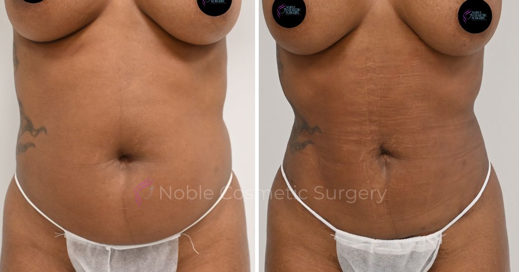 P19-00919L | Before and After Liposuction 1