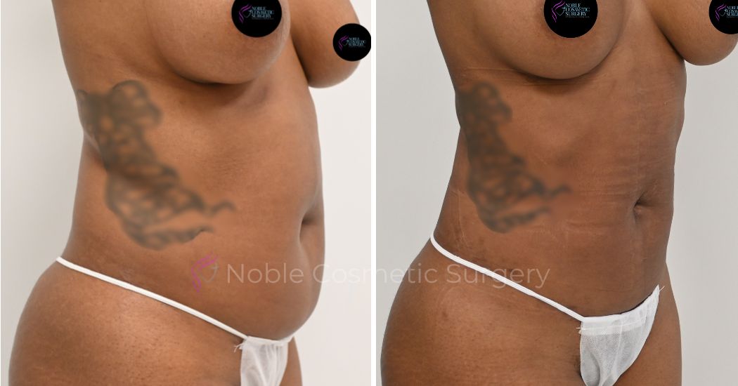 P19-00919L | Before and After Liposuction 2