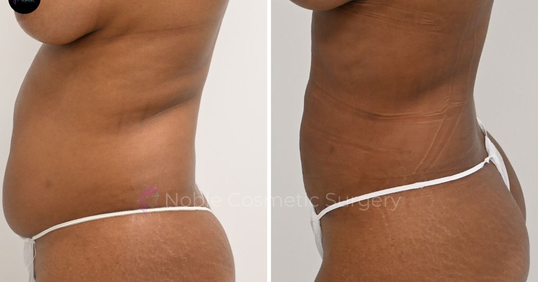 P19-00919L | Before and After Liposuction 3