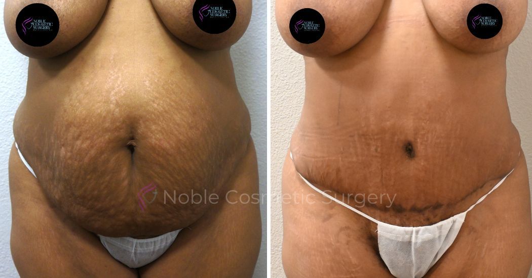 P2-00033A | Before and After Abdominoplasty 1