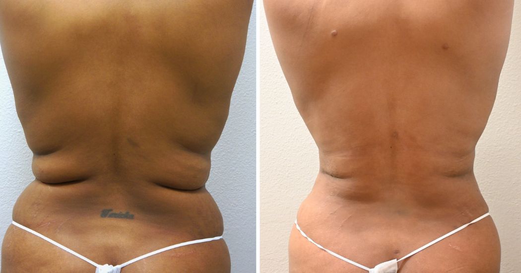 P2-00033A | Before and After Abdominoplasty 3