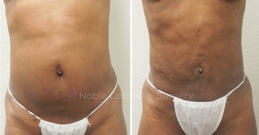 Liposuction 3