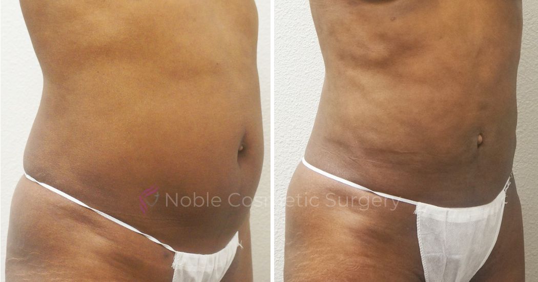 P2-00902 | Before and After Liposuction 2