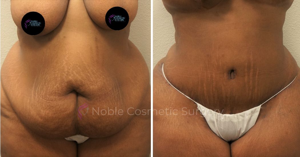 P20-00051A | Before and After Abdominoplasty 1