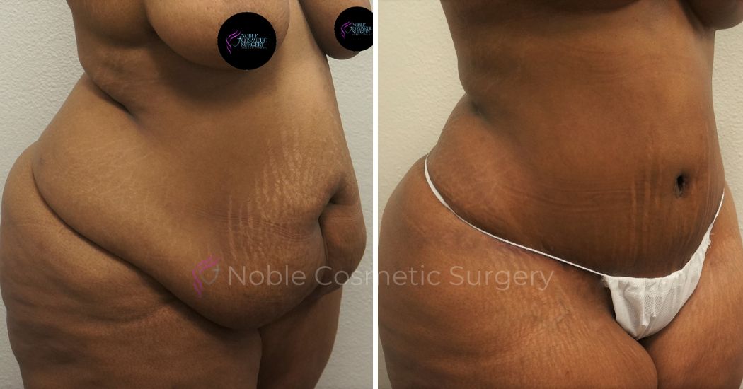 P20-00051A | Before and After Abdominoplasty 2