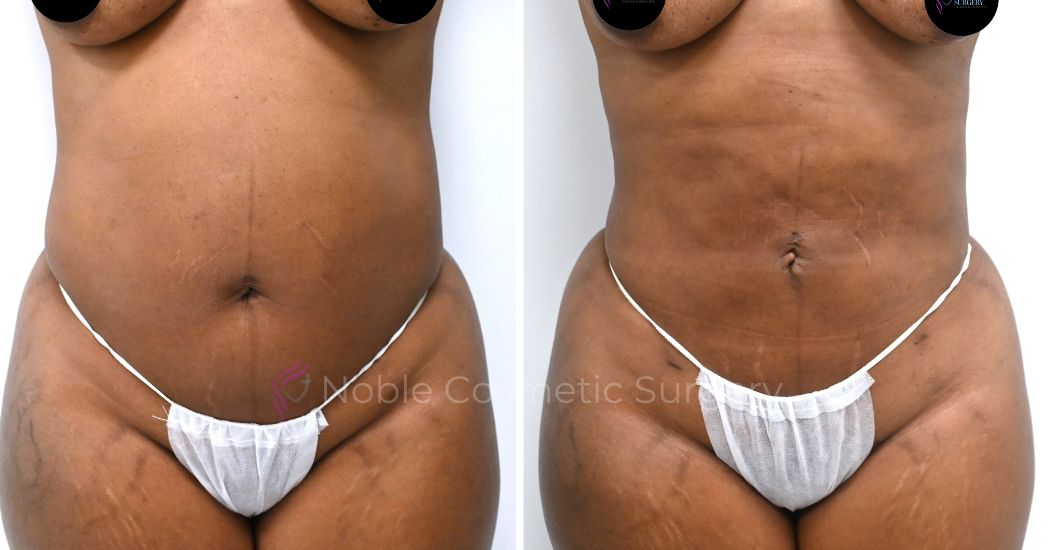 P20-00920L | Before and After Liposuction 1