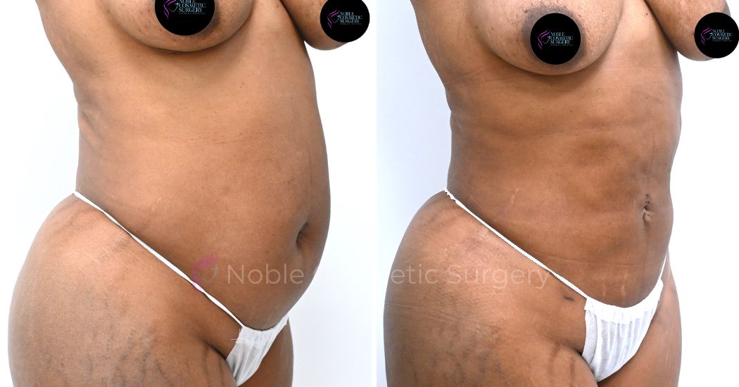 P20-00920L | Before and After Liposuction 2
