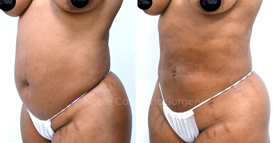 P20-00920L | Before and After Liposuction 3