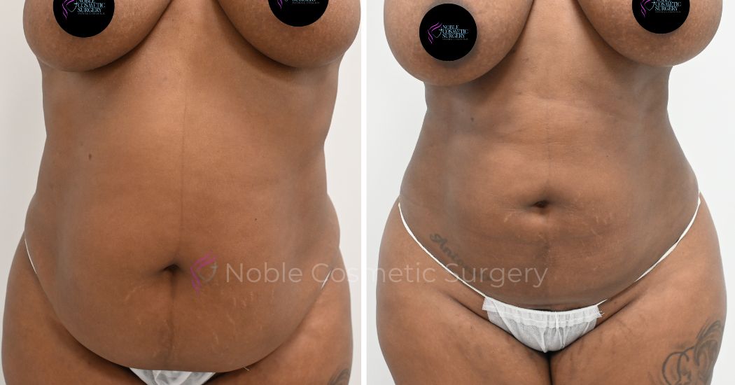P21-00921L | Before and After Liposuction 1