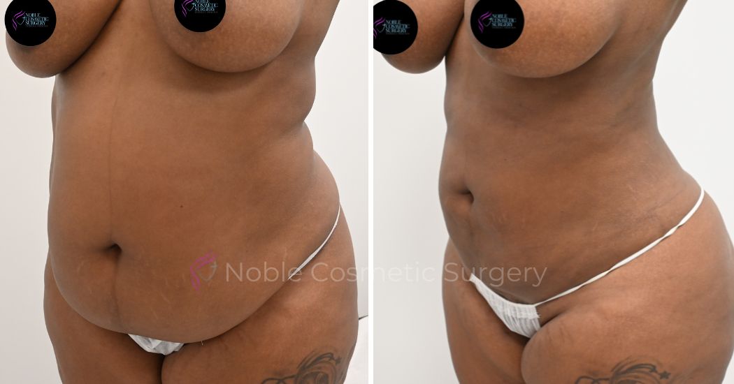 P21-00921L | Before and After Liposuction 2