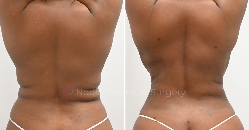 P21-00921L | Before and After Liposuction 3