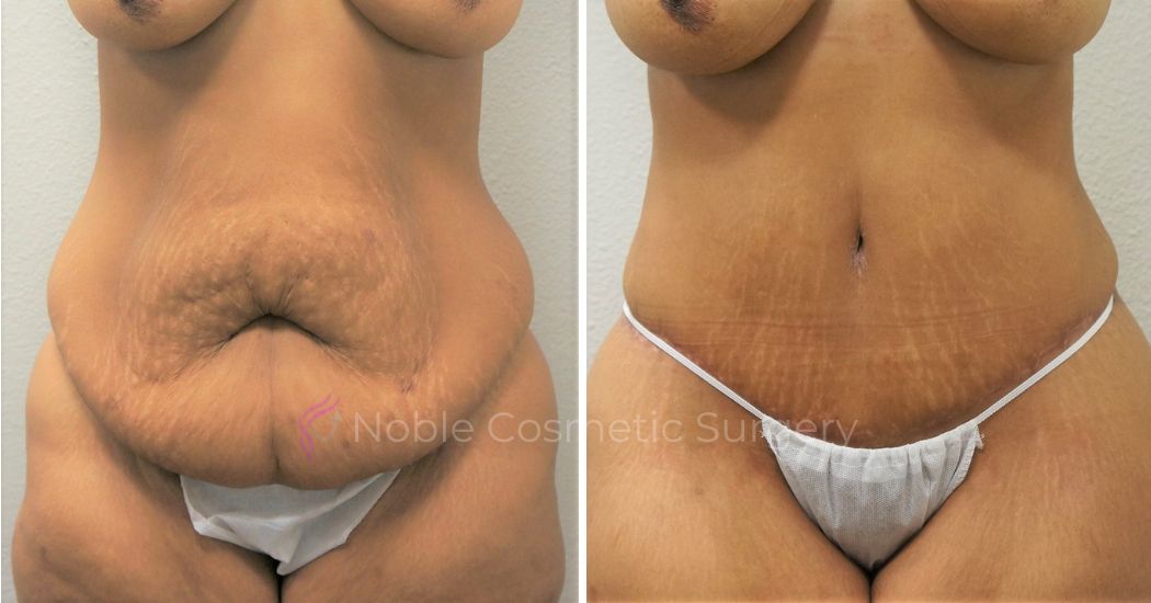 P22-00301A | Before and After Abdominoplasty 1