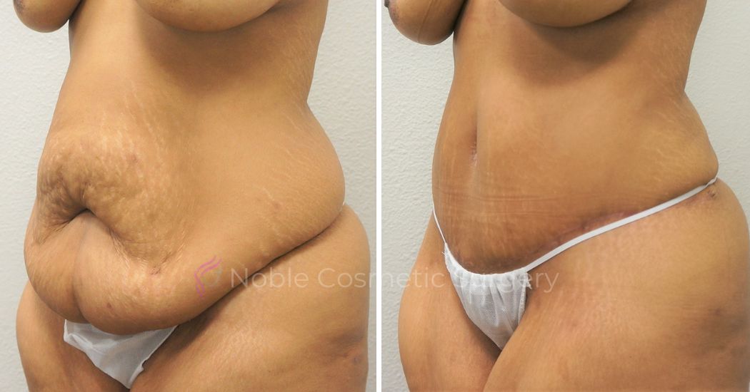 P22-00301A | Before and After Abdominoplasty 2