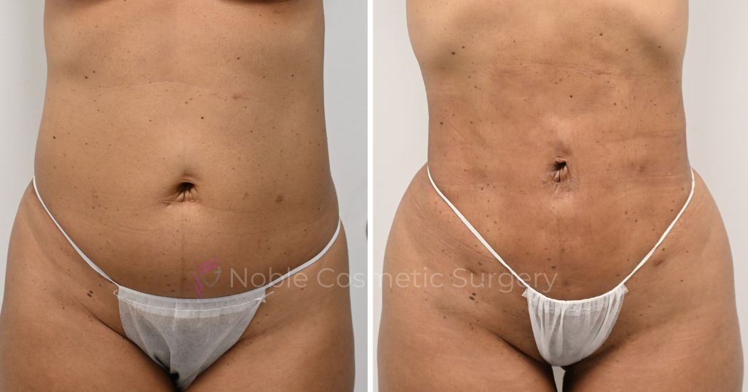 P22-00922L | Before and After Liposuction 1