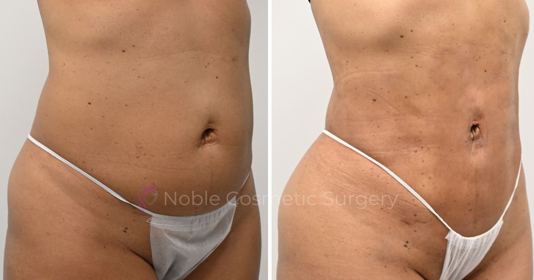 P22-00922L | Before and After Liposuction 2