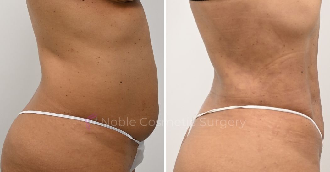 P22-00922L | Before and After Liposuction 3