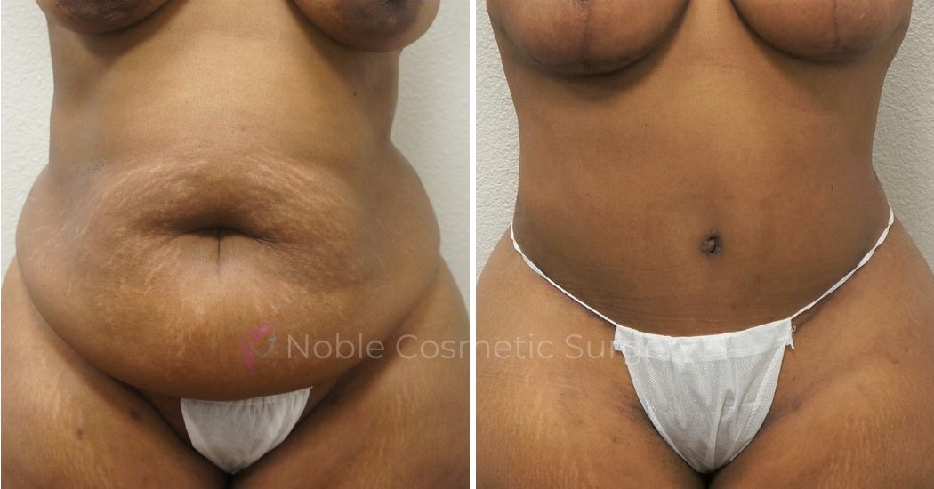 P23-00302A | Before and After Abdominoplasty 1
