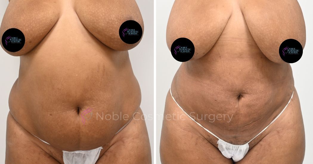 P23-00923L | Before and After Liposuction 1