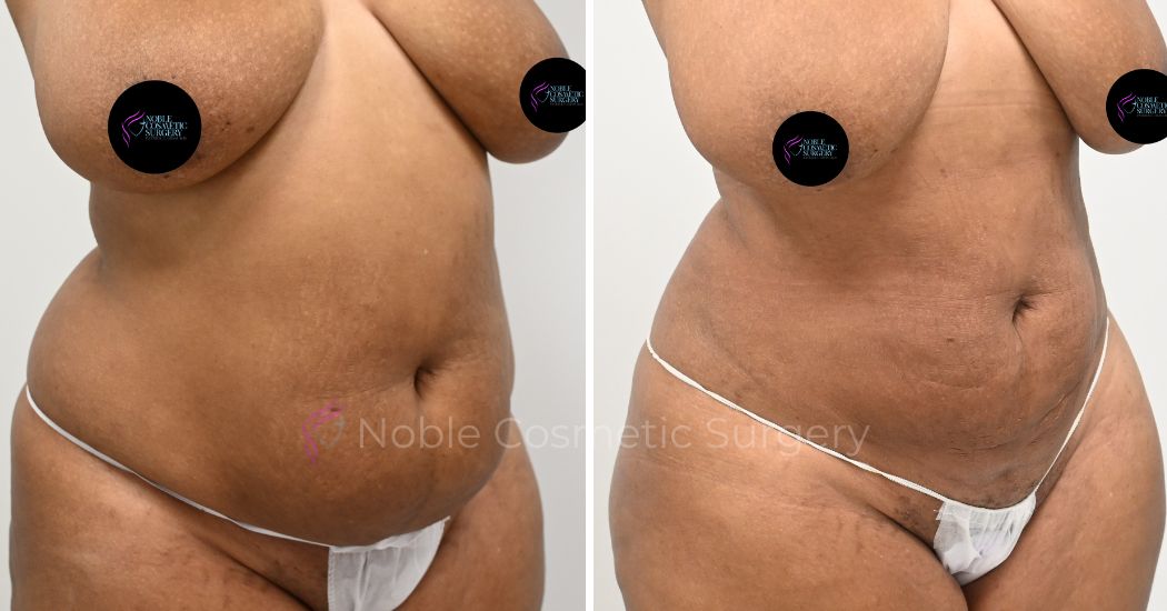 P23-00923L | Before and After Liposuction 2