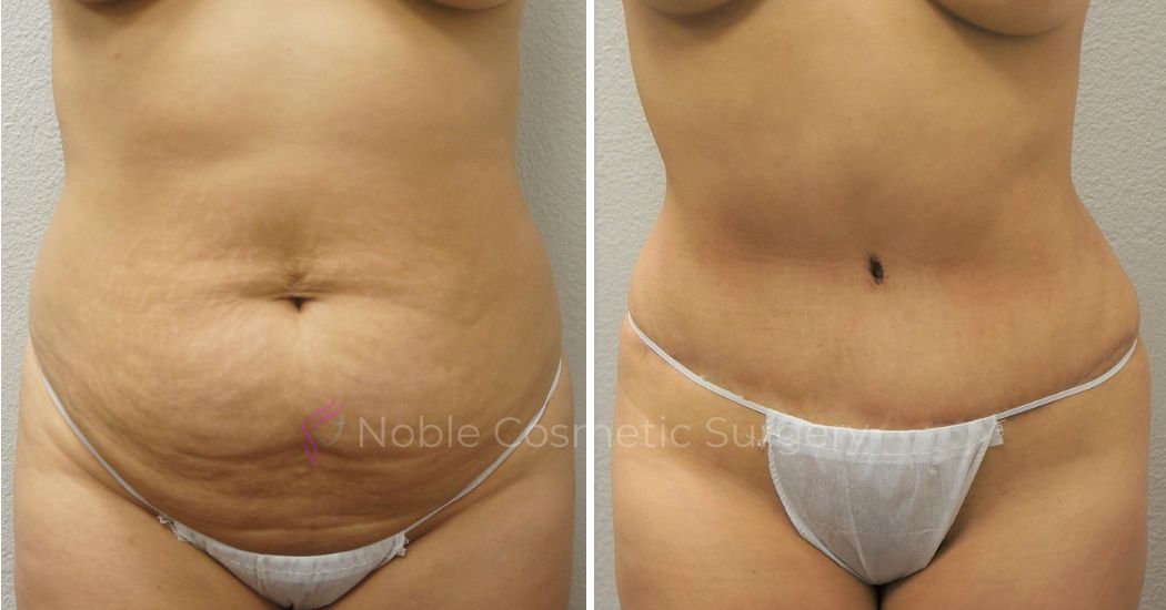 P24-00304A | Before and After Abdominoplasty 1