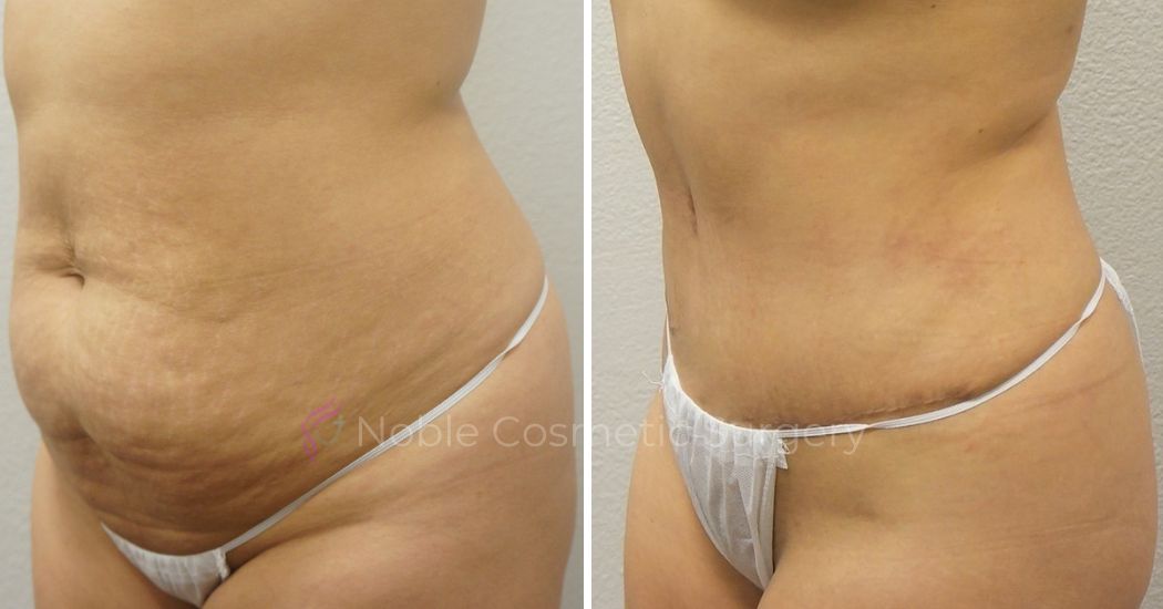 P24-00304A | Before and After Abdominoplasty 2