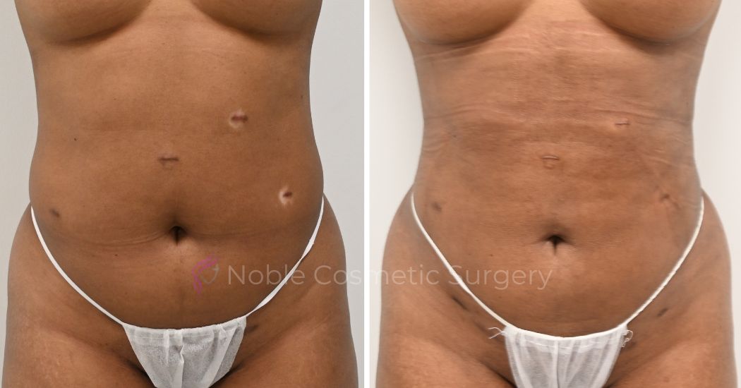 P24-00924L | Before and After Liposuction 1
