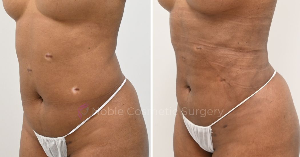 P24-00924L | Before and After Liposuction 2