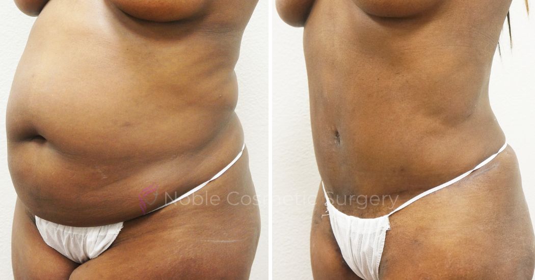 P25-00305A | Before and After Abdominoplasty 2