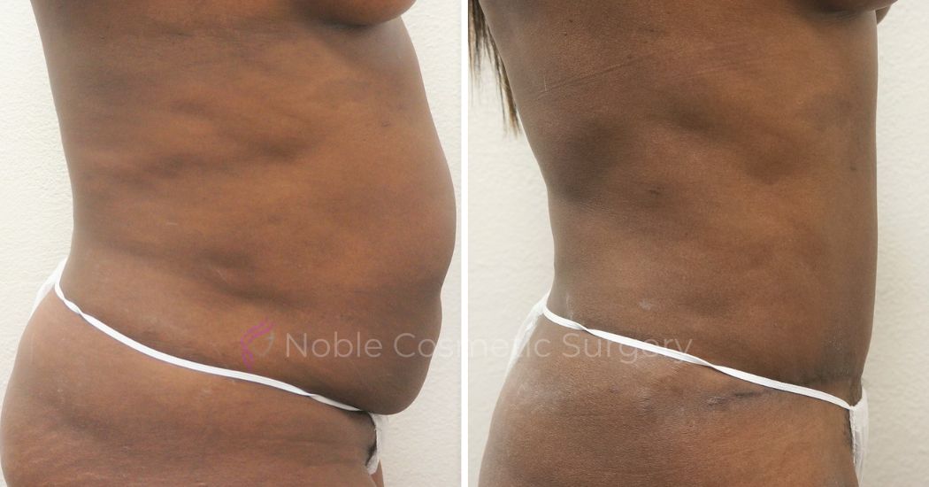 P25-00305A | Before and After Abdominoplasty 3