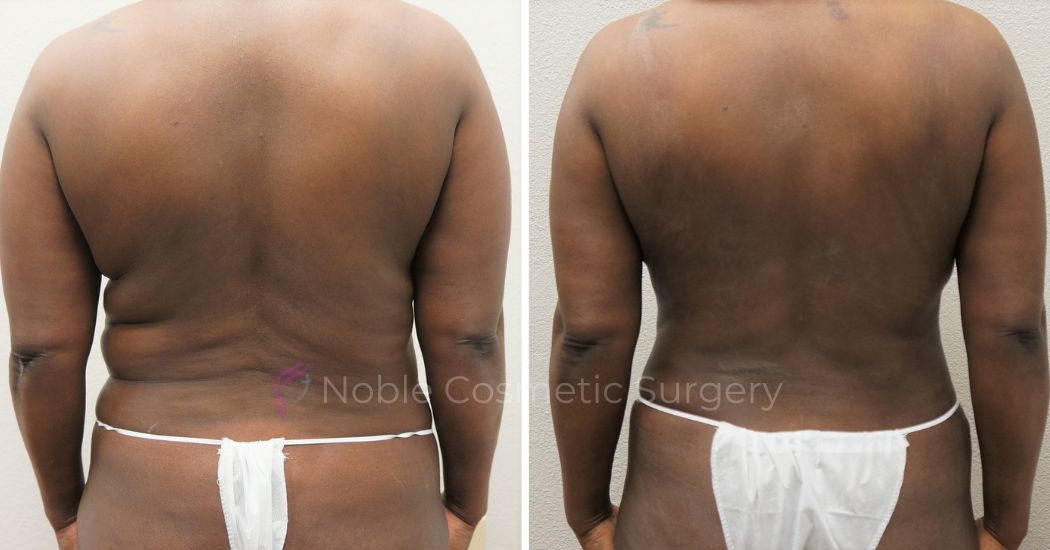 P25-00305A | Before and After Abdominoplasty 4