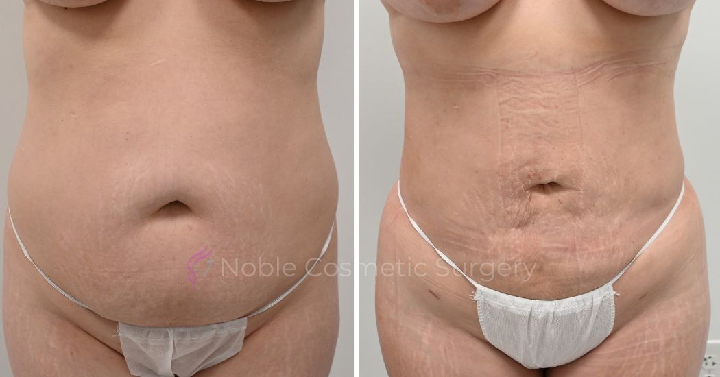 P25-00925L | Before and After Liposuction 1