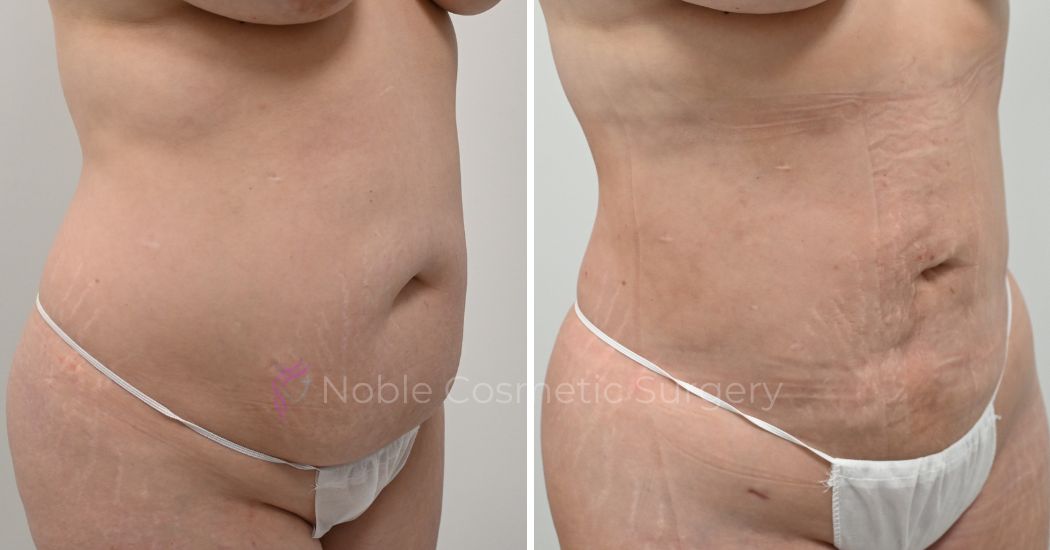 P25-00925L | Before and After Liposuction 2