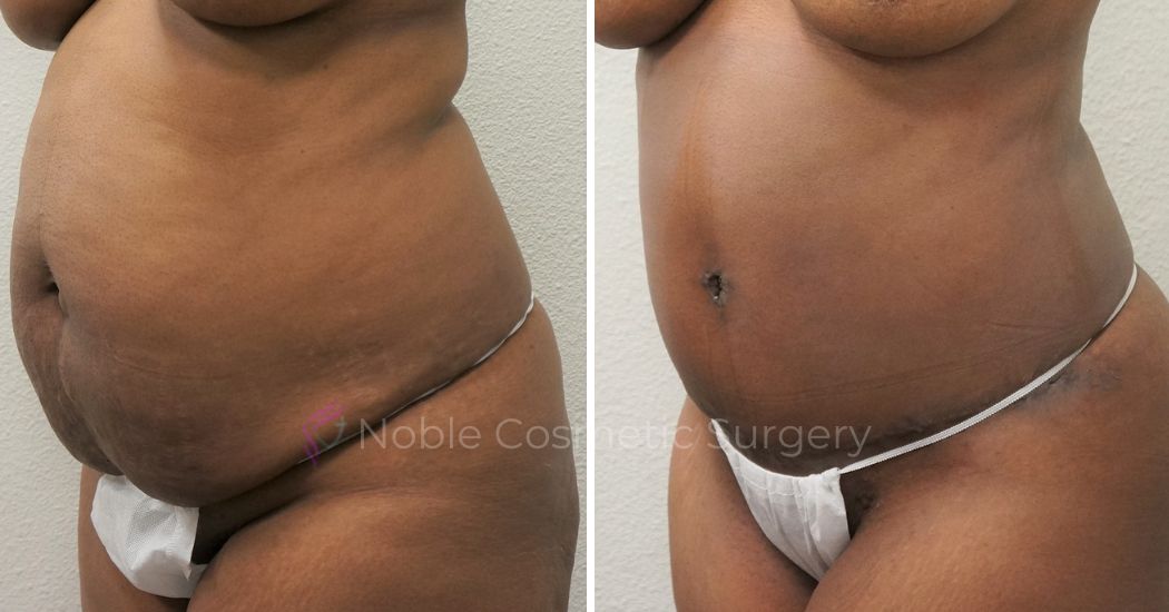 P26-00306A | Before and After Abdominoplasty 2