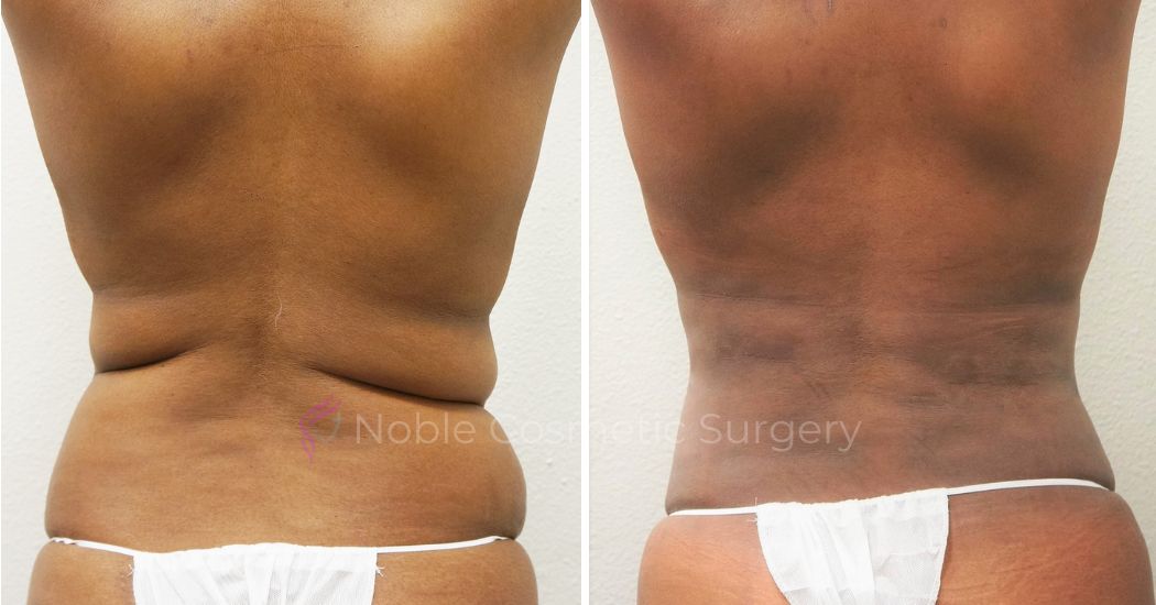P26-00306A | Before and After Abdominoplasty 3