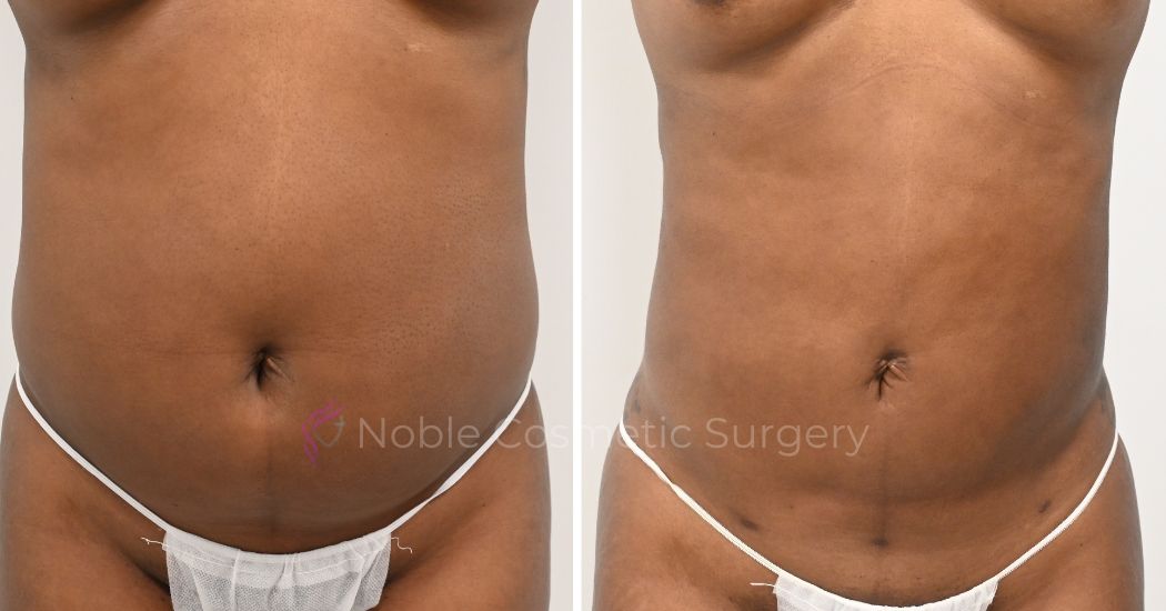 P26-00926L | Before and After Liposuction 1