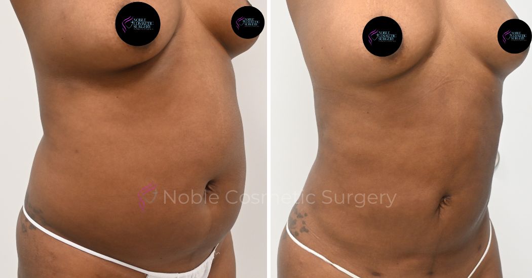 P26-00926L | Before and After Liposuction 2