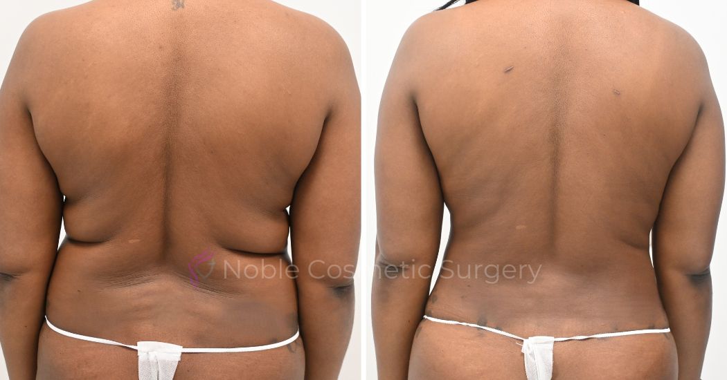 p26 lipo