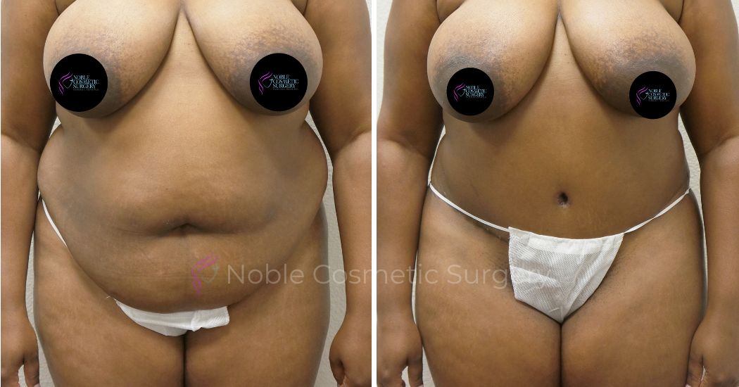 P27-00307A | Before and After Abdominoplasty 1