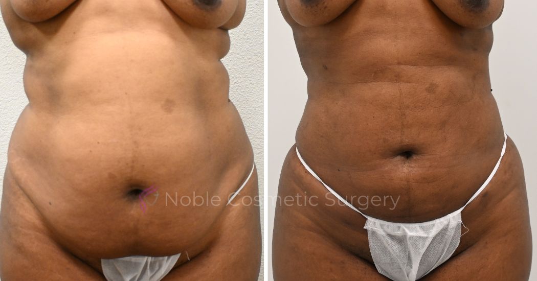 P27-00927L | Before and After Liposuction 1