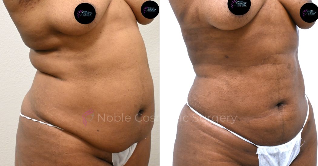 P27-00927L | Before and After Liposuction 2