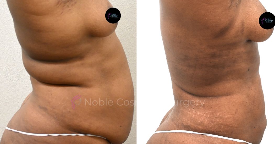 P27-00927L | Before and After Liposuction 3