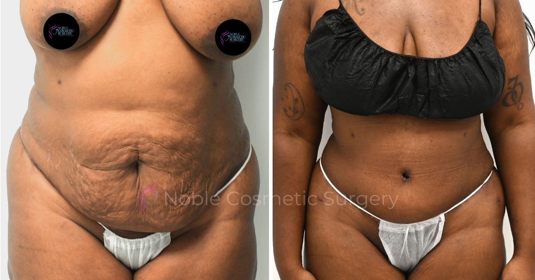 P28-00308A | Before and After Abdominoplasty 1