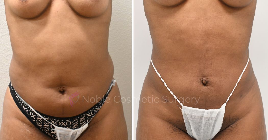 P28-00928L | Before and After Liposuction 1