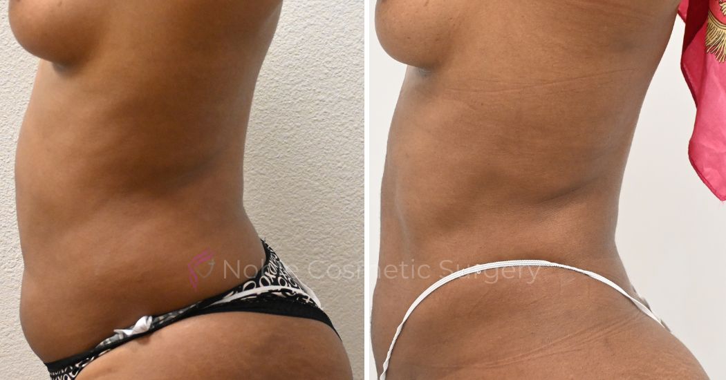 P28-00928L | Before and After Liposuction 2