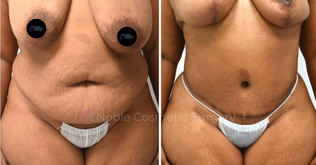 P29-00309A | Before and After Abdominoplasty 1