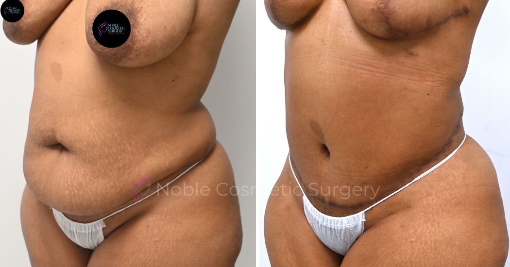 P29-00309A | Before and After Abdominoplasty 2