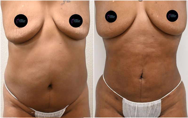 P29-00929L | Before and After Liposuction 1