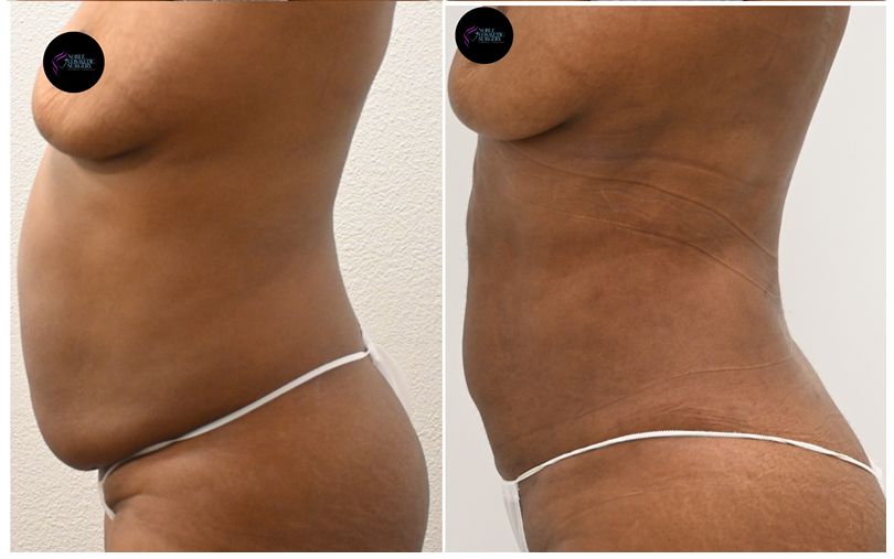 P29-00929L | Before and After Liposuction 2